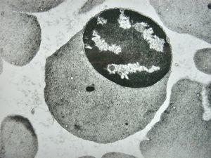 F,43y. | blood - hairy cell leukemia - normoblast F,43y. | blood - hairy cell leukemia - normoblast